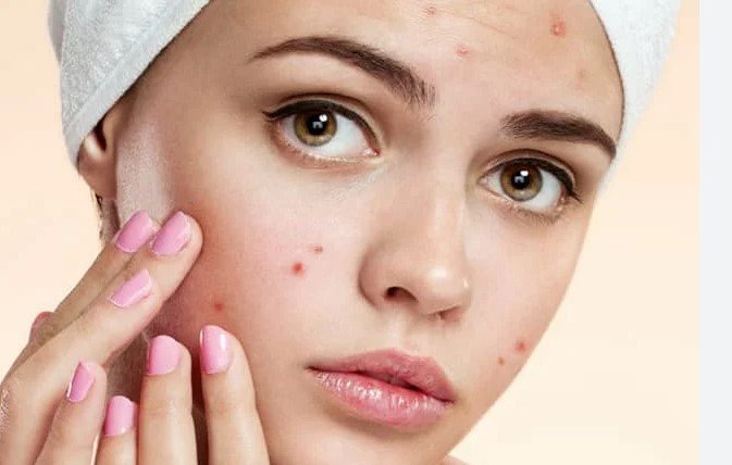 How to remove pimples from face naturally