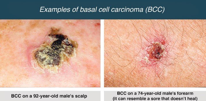Basal Cell Carcinoma Symptoms