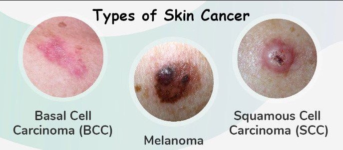 Early Sign Of Basal Cell Carcinoma