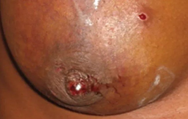 Early-stage-skin-breast-cancer